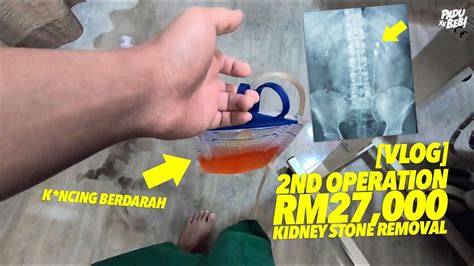 Operation Ke Buang Batu Karang Telan Belanja Rm Youtube