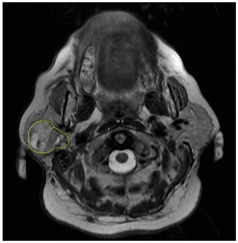 Parotid Gland Tumor Ultrasound