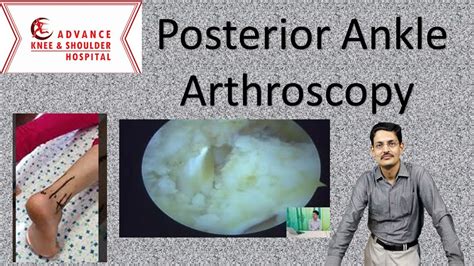 Posterior Ankle Arthroscopy Indications And Techniques YouTube