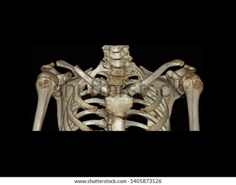 3d Ct Scan Image 3d Reconstruction 스톡 일러스트 1405873526 Shutterstock