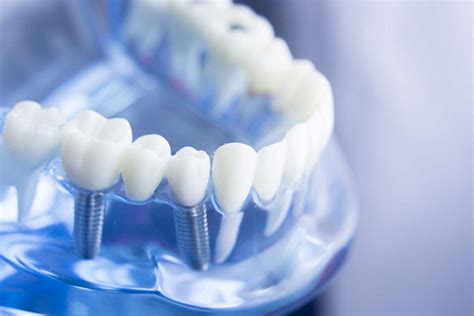 Benefits Of Dental Implants Cosmetic Dentist Meyerland Texas