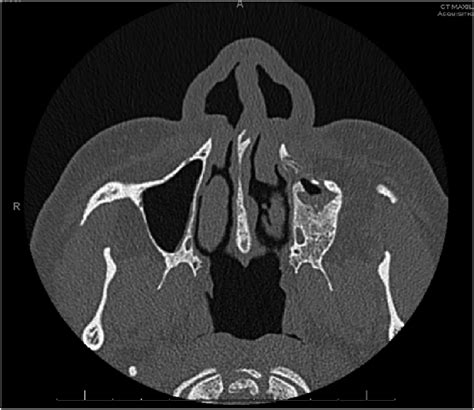 CT of the sinuses without contrast: Chronic left maxillary sinusitis ...