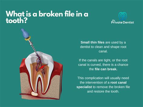 Root Canal Specialist Are They Worth The Extra Cost