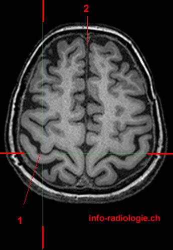 Central Sulcus Fissure Of Rolando W Radiology