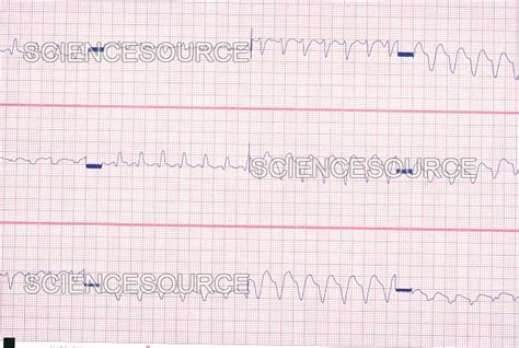 V Tach Ecg Tracings