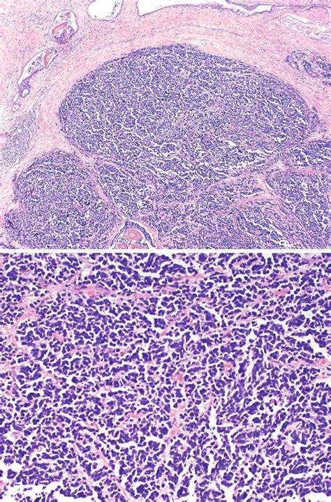 Prostatic Small Cell Carcinoma Hematoxylin And Eosin Stain A Download Scientific Diagram