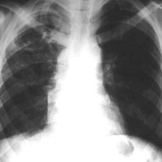 Chest Radiograph Postero Anterior View Showing An Irregular