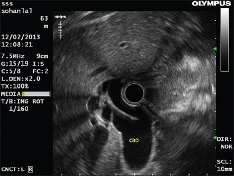 Radial Endoscopic Ultrasound Showing Grossly Dilated Common Bile Duct