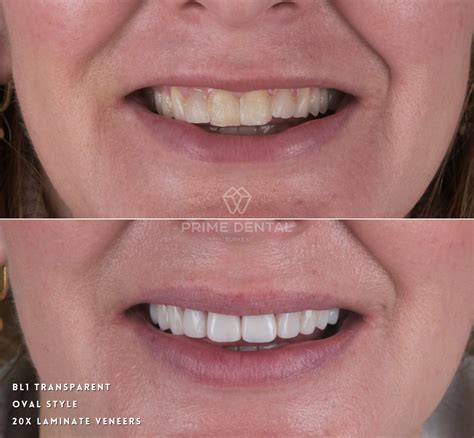 Laminate Veneer Before After Photos - Prime Dental Turkey