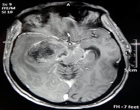 [PDF] Brain herniation | Semantic Scholar