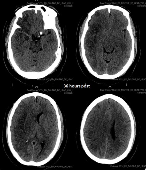 Case Archives Stroke CT vs CT Perfusion | neuroangio.org