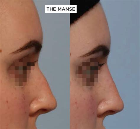 Nose Filler Non Surgical Rhinoplasty At Our Expert Sydney Clinic