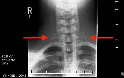 Cervical Ribs in a Teenaged Athlete | Consultant360