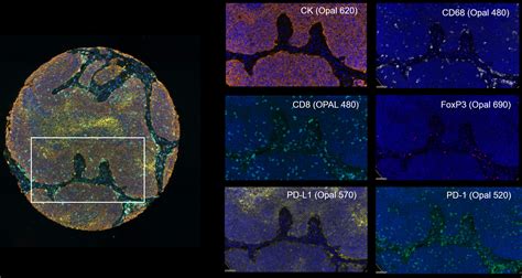 Spatial Phenotyping In Digital Pathology Defining A Multiplex IF Image