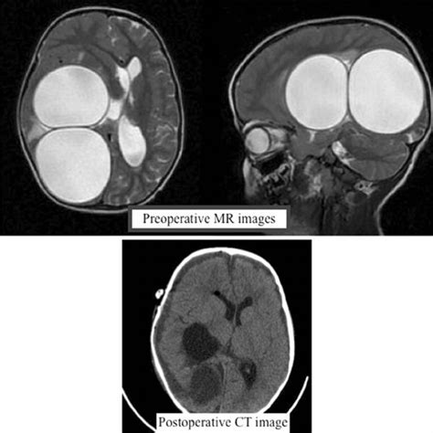 T2 Weighted Mr Image Of A Smooth Edged 6 Cm Diameter Hydatid Cyst In