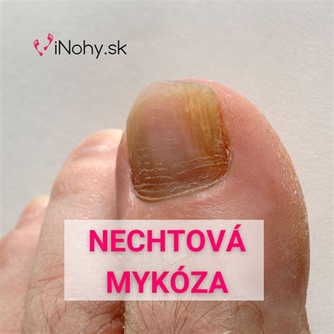 Nechtová mykóza iNohy sk