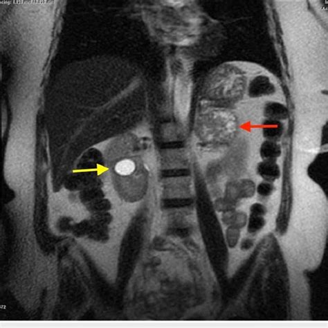 Coronal View T2 Weighted Mri Showing A Left Adrenal Mass Red Arrow