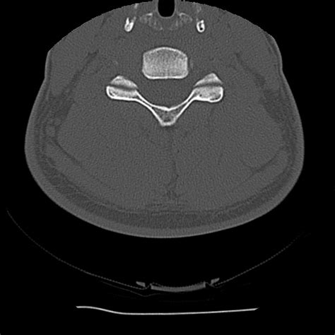 File Normal Trauma Chest Pelvis And Spine Imaging Radiopaedia