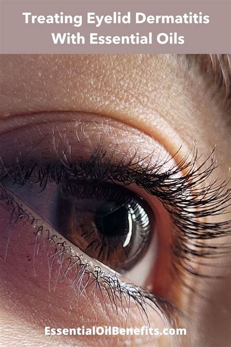 Eyelid dermatitis – Artofit