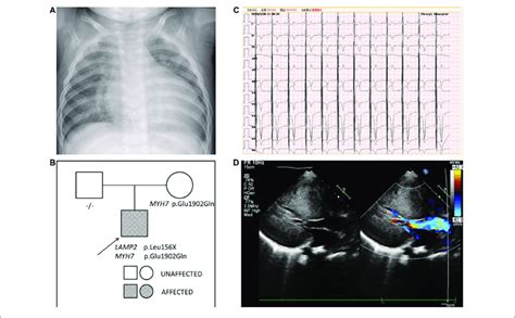 A The Chest X Ray Of Patient 2 Demonstrated An Enlarged Cardiac