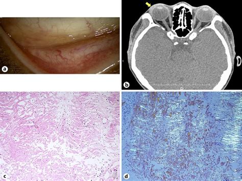 Figure 1 From Amyloidosis In The Palpebral Conjunctiva Mimicking