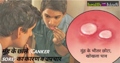 Mouth Ulcer Canker Sore