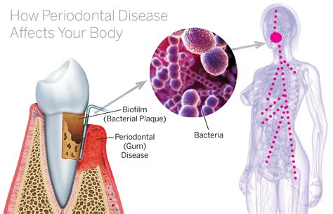 Systemic Complications Pristine Periodontics And Implants