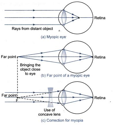 What is myopia? State the two causes of myopia - CBSE Class 10 Science - Learn CBSE Forum