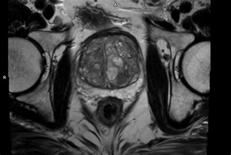 Multiparametric Mri Prostate