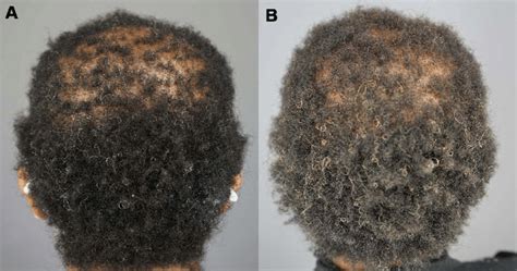 Right parietal area and vertex of patient 3 Images of the vertex and ...