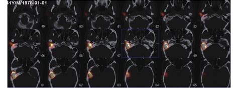 SPECT CT核素显像在咽鼓管功能的临床研究