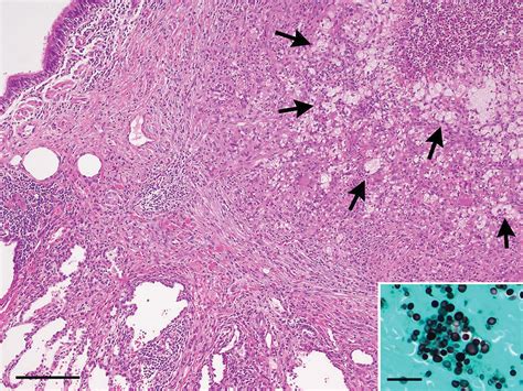 Pulmonary Cryptococcosis Mimicking A Metastasis In A Patient With Ewing Sarcoma Sakamoto