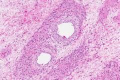 Juvenile Nasopharyngeal Angiofibroma Ottawa Atlas Of Pathology