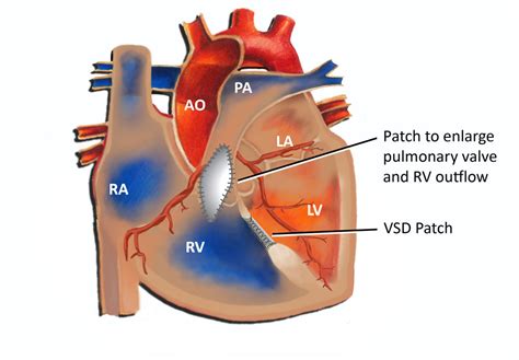 Tetralogy Of Fallot Pediatric Cardiology Associates Of Houston