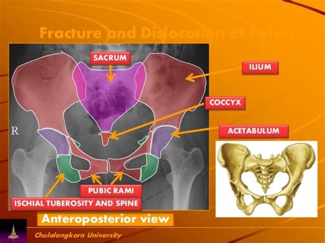 True Pelvis Vs. False Pelvis