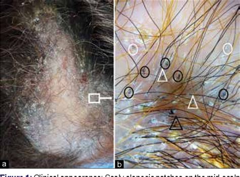 Figure 1 From Two Erratic Cases Of Tinea Capitis In Adults Utility Of