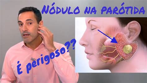 Nódulo na parótida o que pode ser um nódulo da glândula parótida YouTube