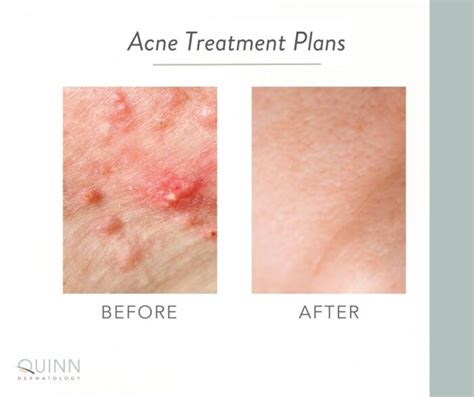 Treating Adult Acne Quinn Dermatology