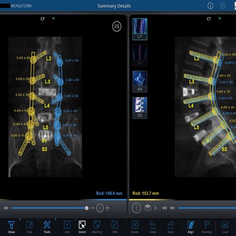 Case 1 Preoperative Planning For Robotic Assisted Placement Of Pedicle