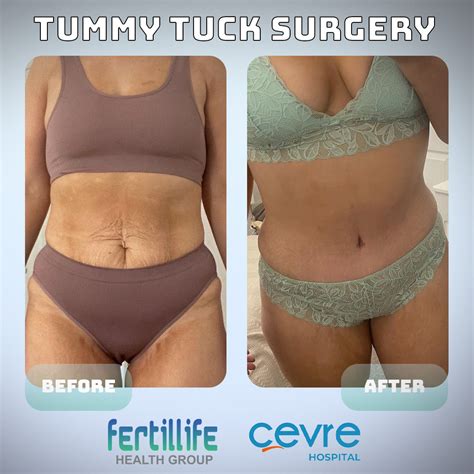 Tummy Tuck Abdominoplasty Surgery In Istanbul