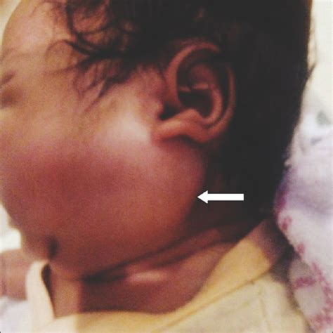 Parotid Gland Swelling In Children