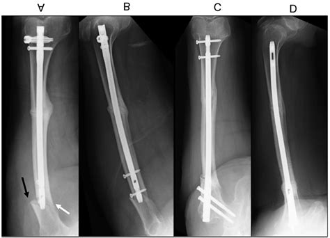 Case Plain Radiographs Of The Right Femur Demonstrating The