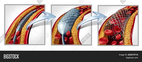 Coronary Stent Image & Photo (Free Trial) | Bigstock