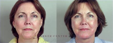 Facelift Before And After Pictures Case 7 Paramus New Jersey Parker Center For Plastic Surgery