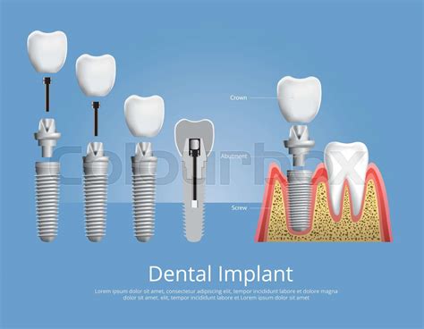 Human Teeth And Dental Implant Vector Illustration Stock Vector