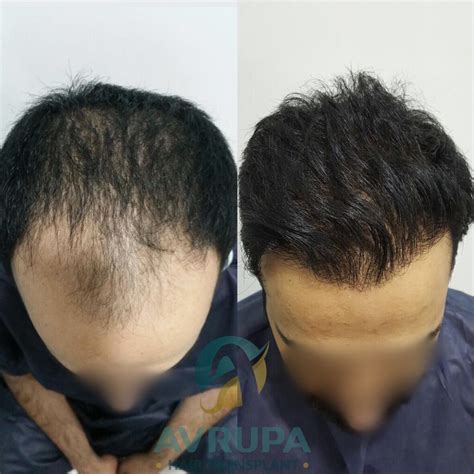 Hair Transplant Results After 9 Months Before And After 4200 Grafts