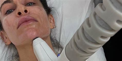 I Tried Sofwave A New Skin Tightening Treatment PS Beauty