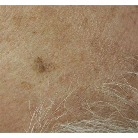 Seborrheic keratosis dermoscopy: (a) cerebriform pattern (brain-like ...