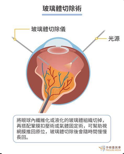 視網膜剝離症狀有哪些？前兆、症狀、自我檢查、原因、治療一次看