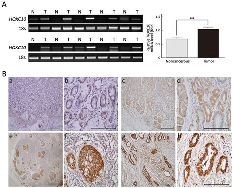 HOXC10 Up Regulation Promotes Gastric Cancer Cell Proliferation And